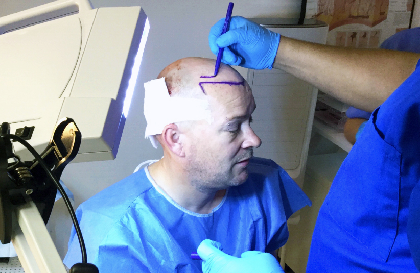 FUE hair transplant surgery procedure