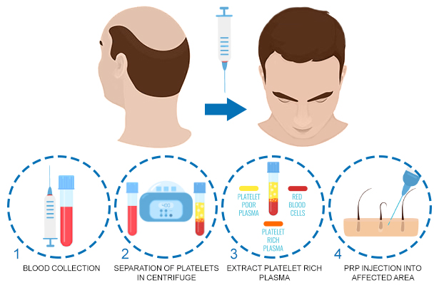 PRP platelet rich plasma treatment process