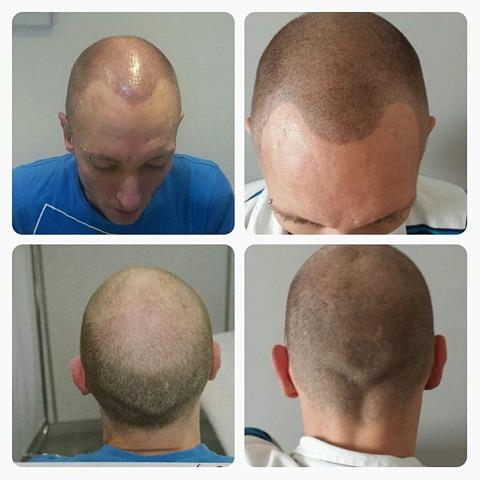 Scalp micro pigmentation before and after